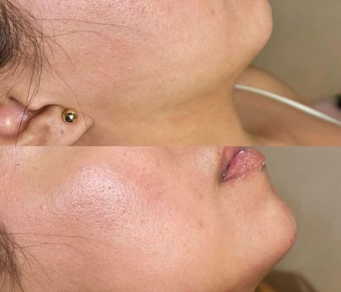 Jawline Fillers Make It Shape by Minh Lashes Beauty Clinic