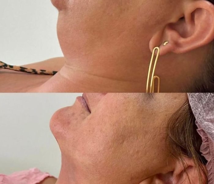 Double Chin Removal with Fat Dissolving and HIFU at Minh Lashes Beauty Clinic